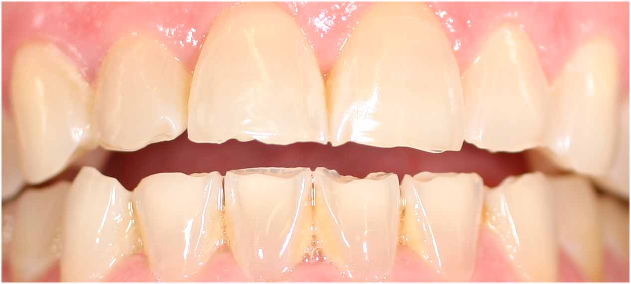 Resultado de imagen de desgastes en los dientes